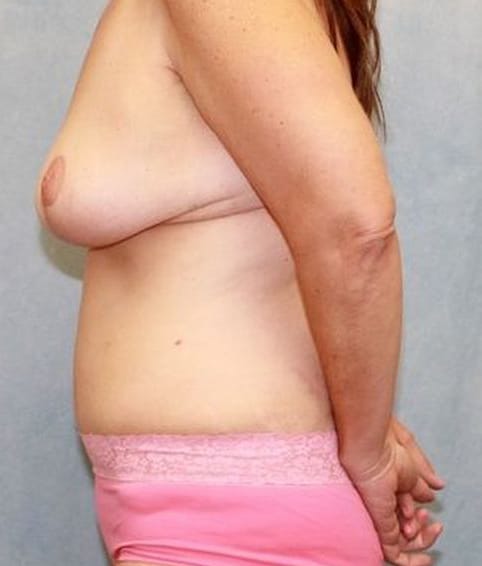 Abdominoplasty - Tummy Tuck