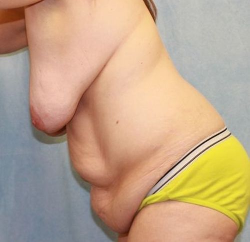 Abdominoplasty - Tummy Tuck