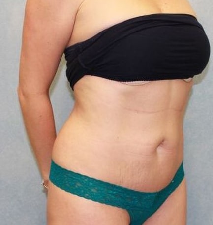 Abdominoplasty - Tummy Tuck