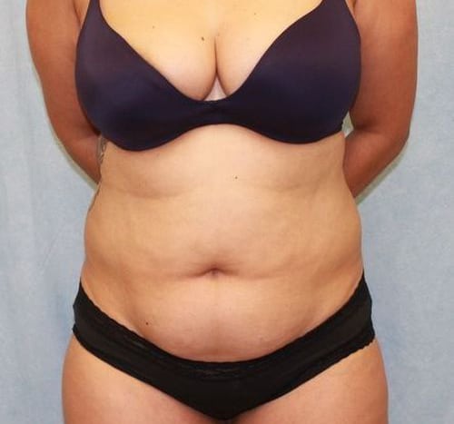 Abdominoplasty - Tummy Tuck