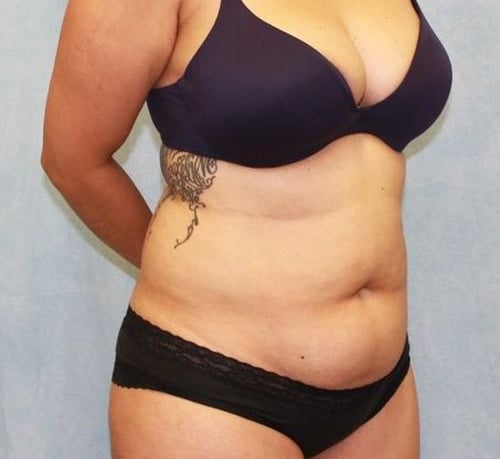Abdominoplasty - Tummy Tuck