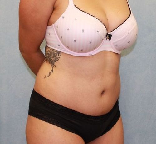 Abdominoplasty - Tummy Tuck