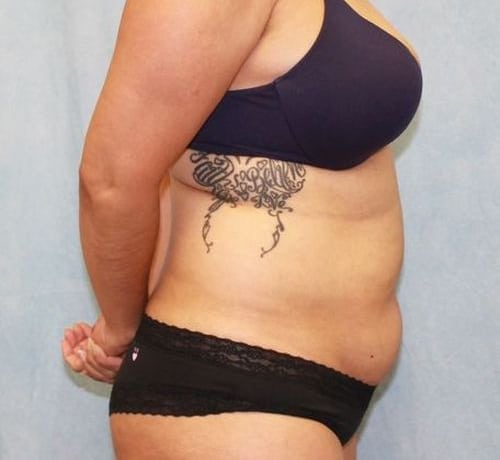 Abdominoplasty - Tummy Tuck