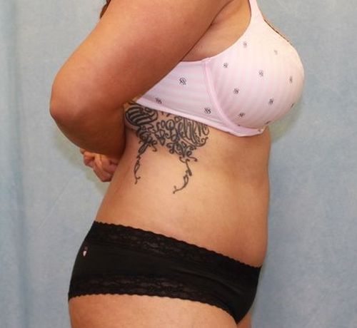 Abdominoplasty - Tummy Tuck