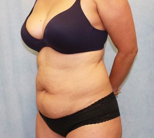 Abdominoplasty - Tummy Tuck