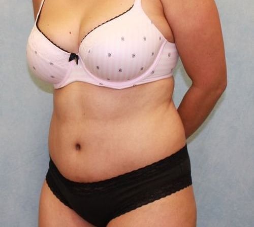 Abdominoplasty - Tummy Tuck