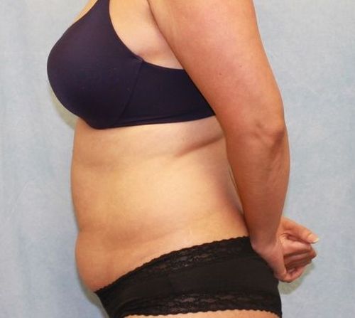 Abdominoplasty - Tummy Tuck