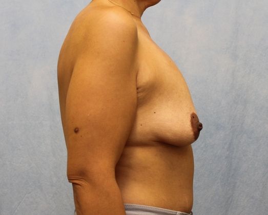 Breast Lift with Implants