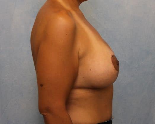Breast Lift with Implants