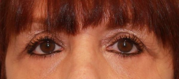 Eye Lift (Blepharoplasty)