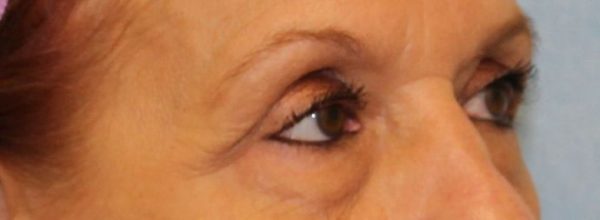 Eye Lift (Blepharoplasty)