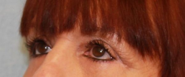 Eye Lift (Blepharoplasty)