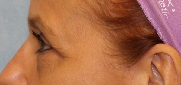 Eye Lift (Blepharoplasty)