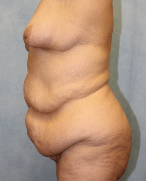 Abdominoplasty + Monsplasty