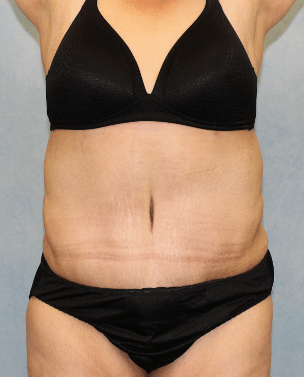 Abdominoplasty + Monsplasty