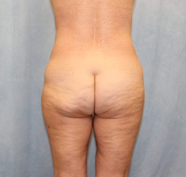 Brazilian Butt Lift