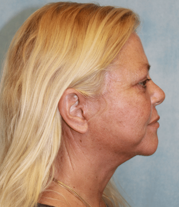 Facelift