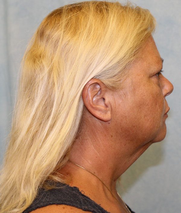 Facelift