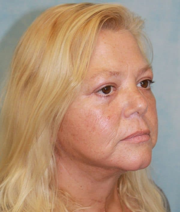 Facelift