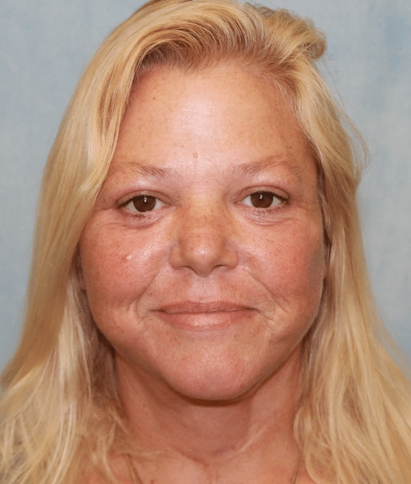 Facelift