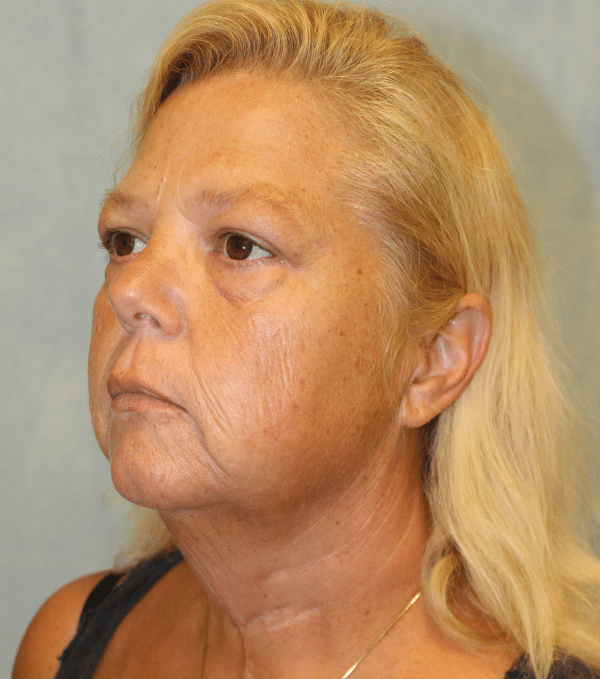 Facelift