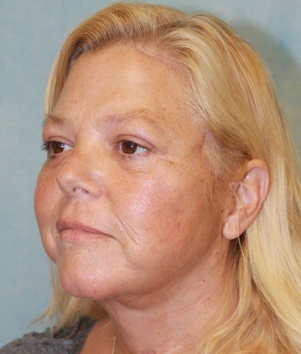Facelift