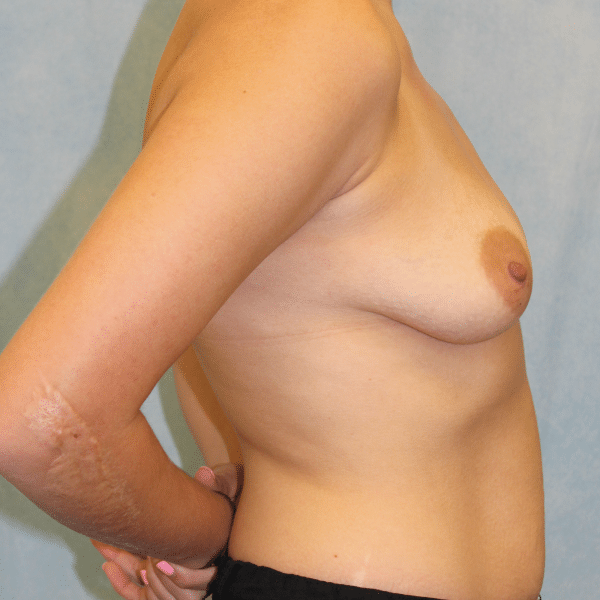 Breast Augmentation