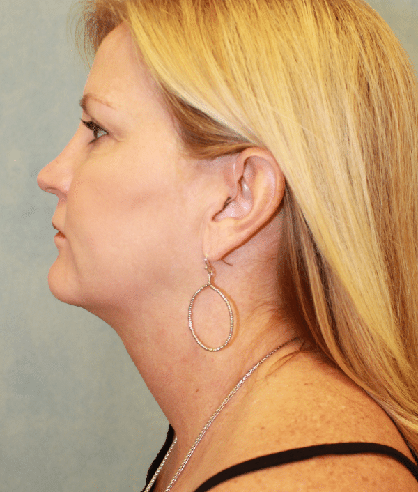 Facelift