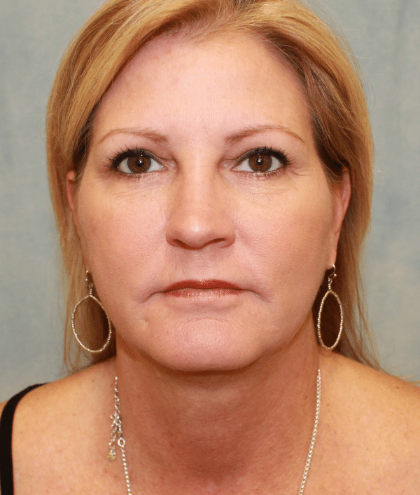 Facelift