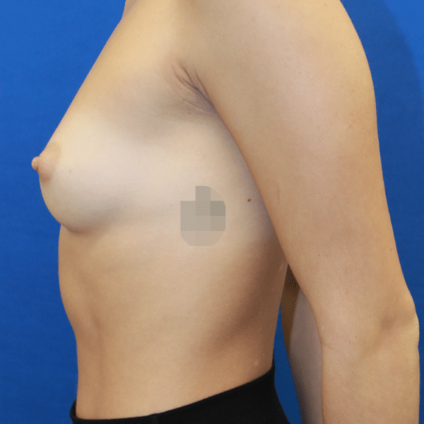 Breast Augmentation