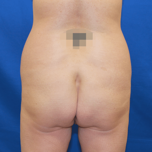 Brazilian Butt Lift
