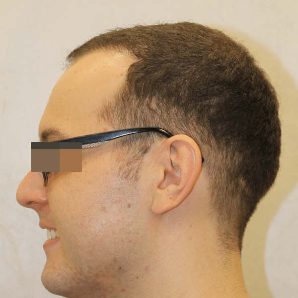 Hair Transplant