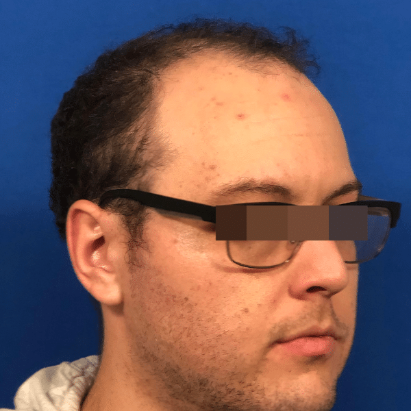 Hair Transplant