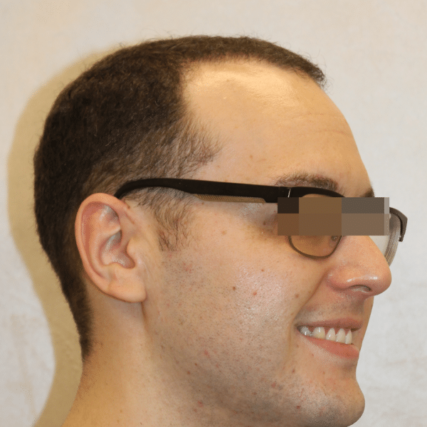 Hair Transplant