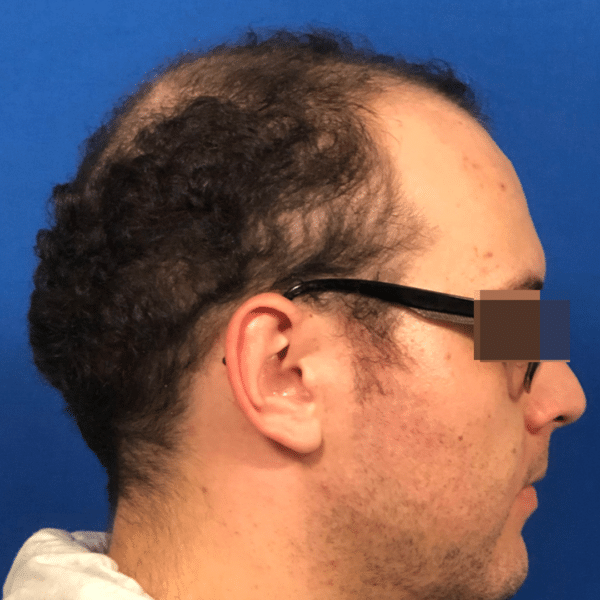 Hair Transplant