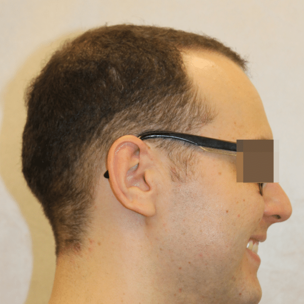 Hair Transplant