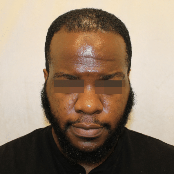 Hair Transplant