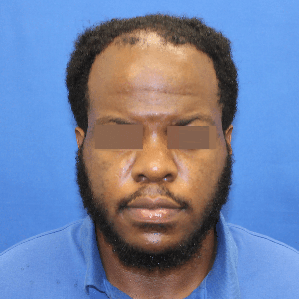 Hair Transplant