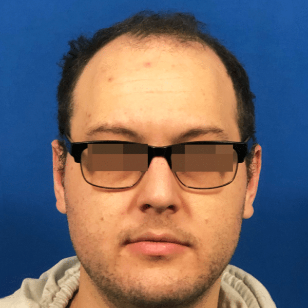 Hair Transplant