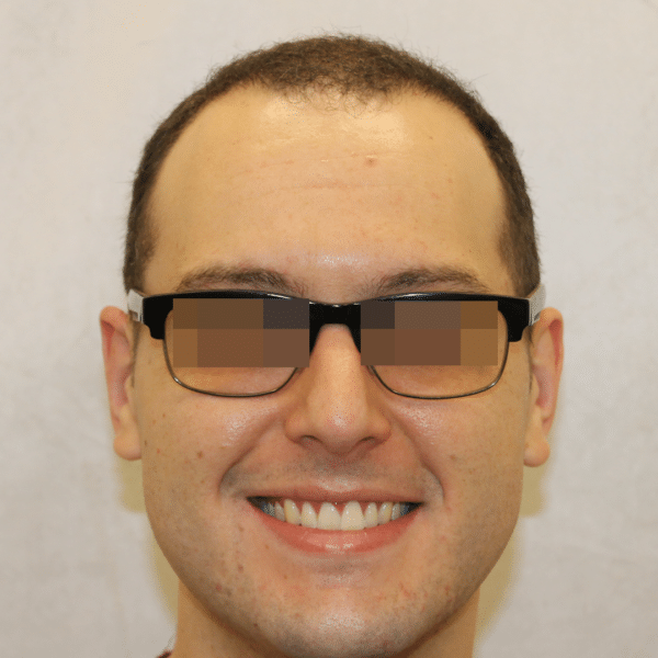 Hair Transplant