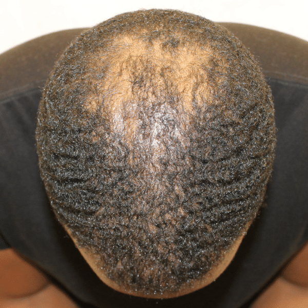 Hair Transplant