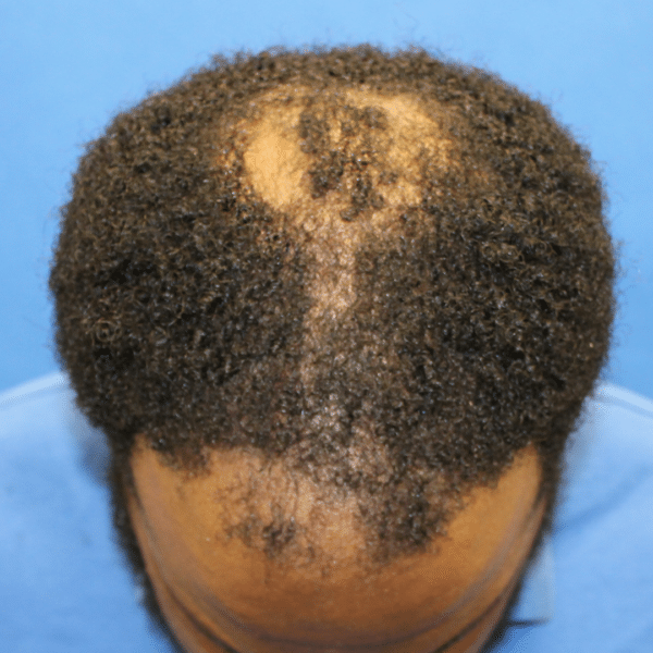 Hair Transplant