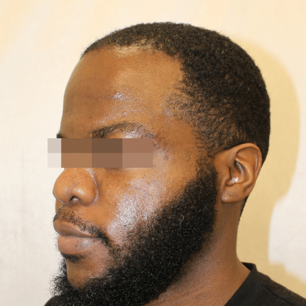 Hair Transplant