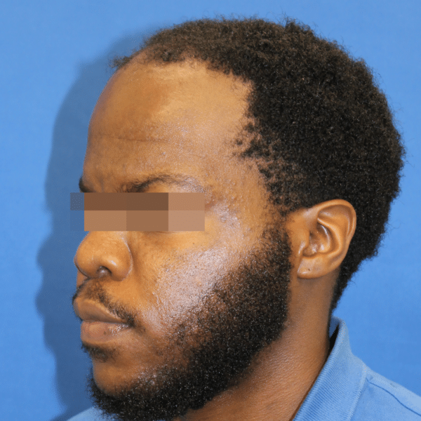 Hair Transplant