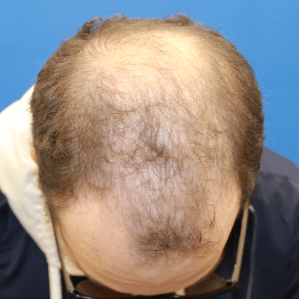 Hair Transplant