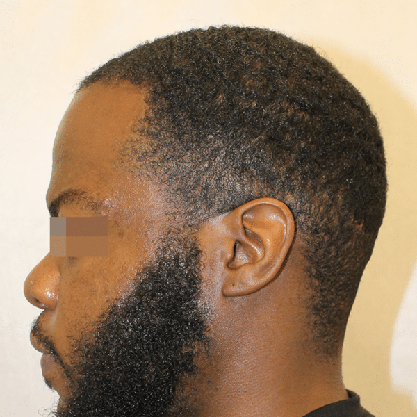 Hair Transplant