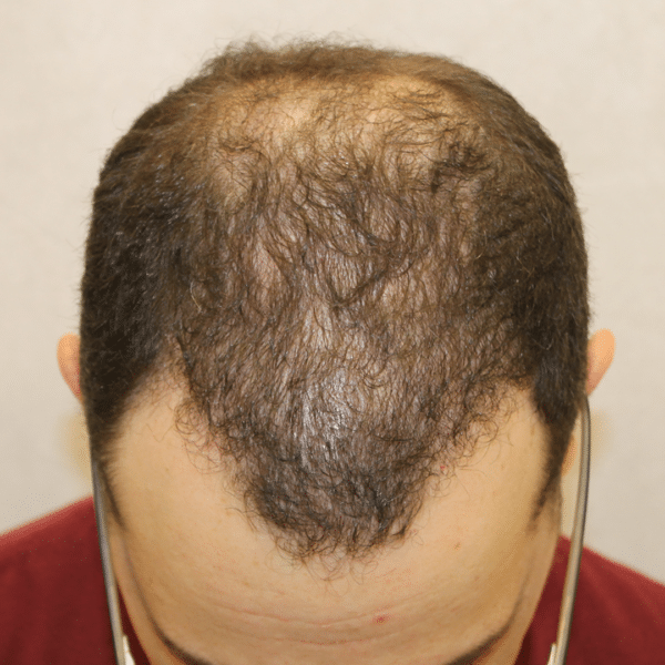 Hair Transplant