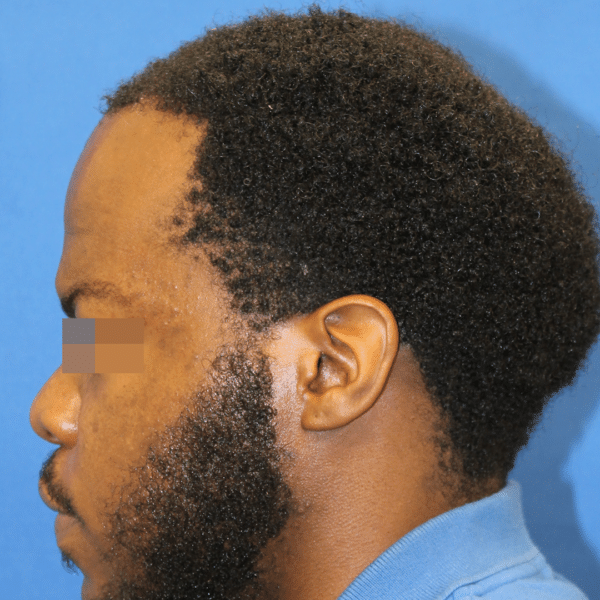 Hair Transplant