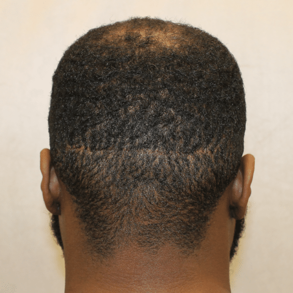 Hair Transplant