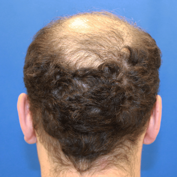 Hair Transplant